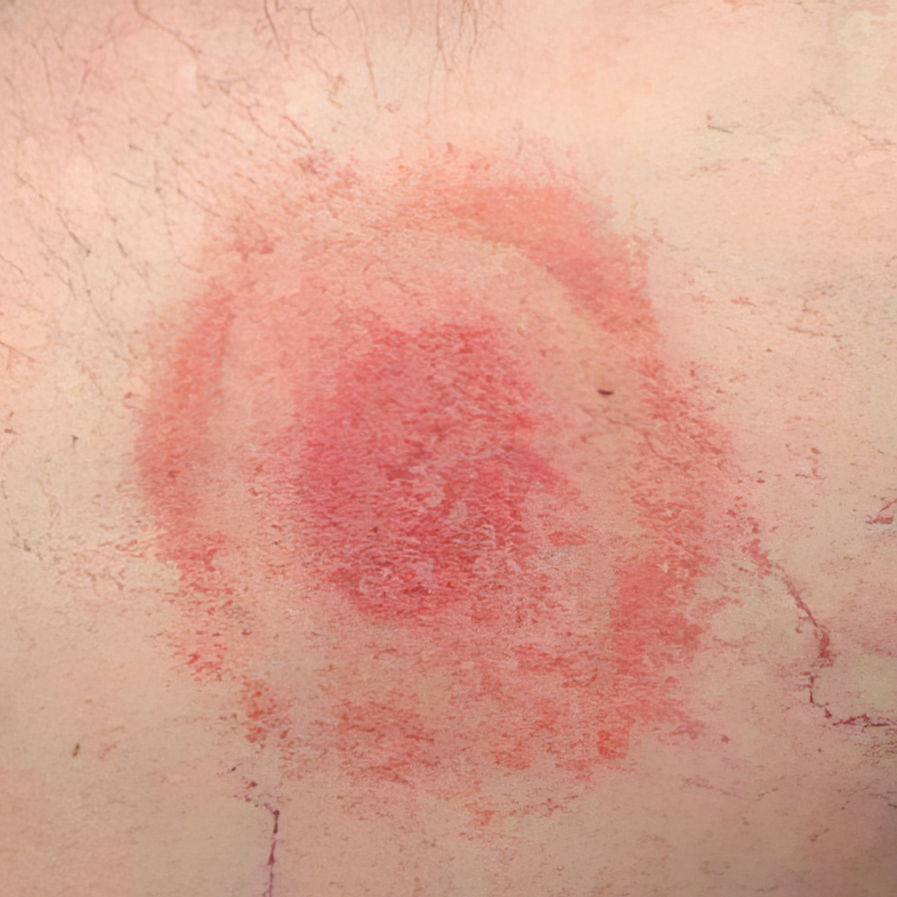 Tick Bonre Rashes Ticks: A Guide for Trail Enthusiasts – The Glengarry Trails